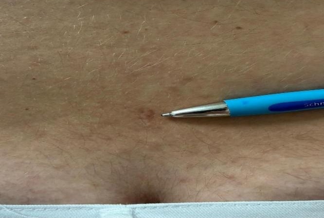 Τομή χειρουργείο απο ενδοσκοπική αφαίρεση δισκοκήλης